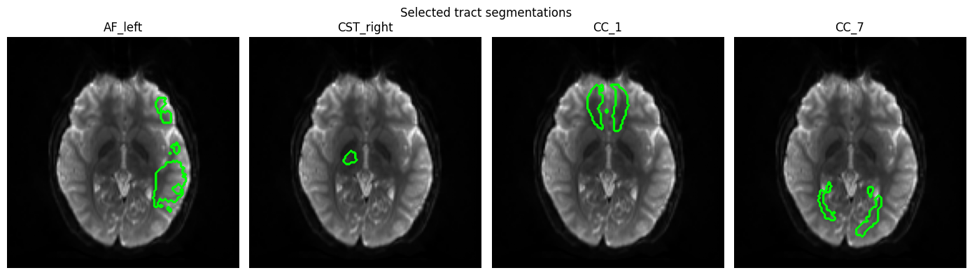 Tract segmentation example